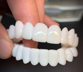 VitaSmile Dental Veneers For Natural Fit And Comfort